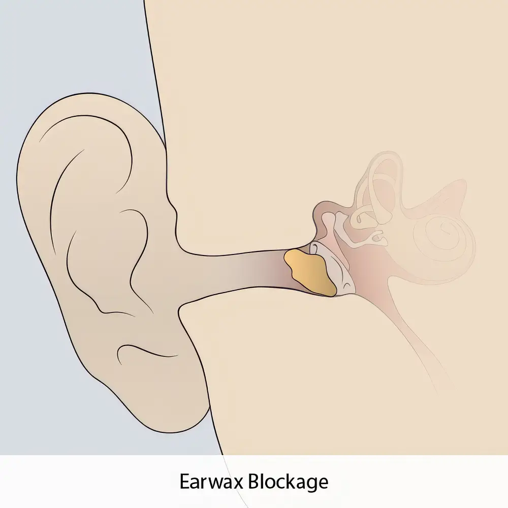 Earwax Blockage