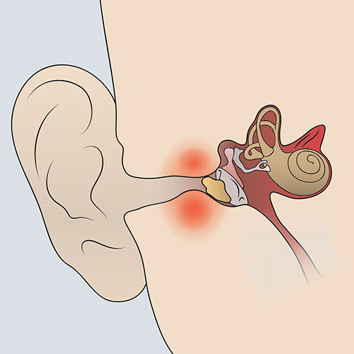 An illustration depicting conductive hearing loss
